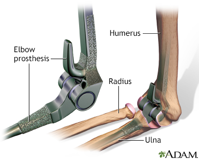 Elbow replacement